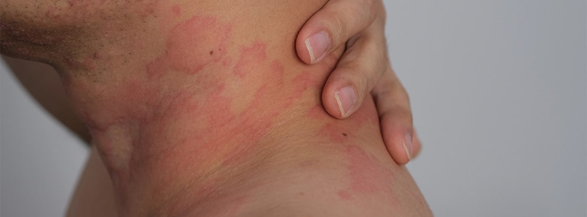 Morfea cutánea Piel con dermatitis