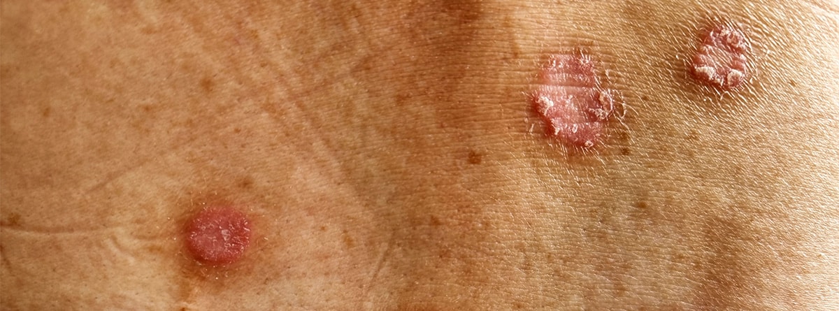 Pioderma gangrenoso Pioderma gangrenoso