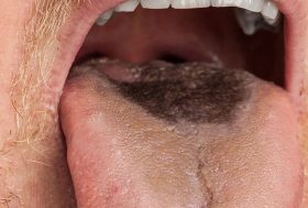 Hombre con lengua vellosa negra