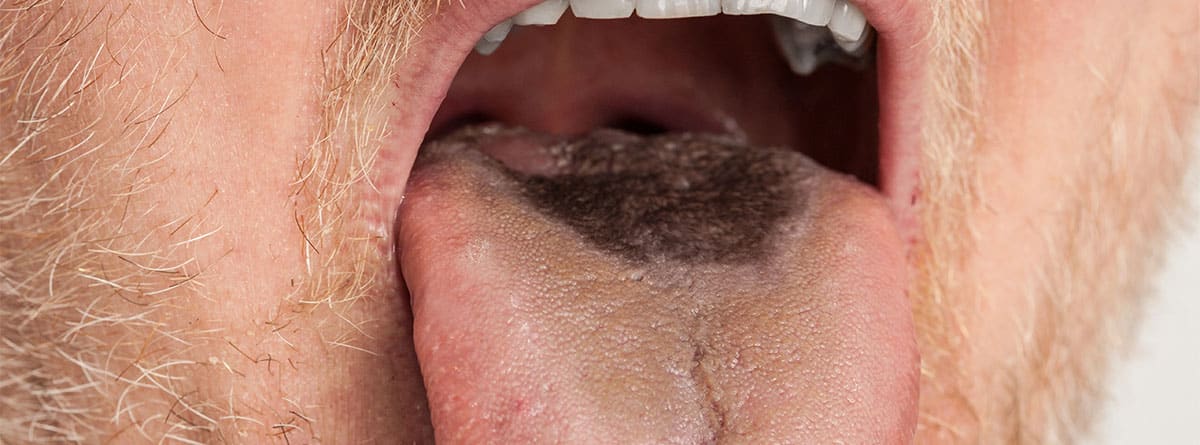 Lengua vellosa negra Hombre con lengua vellosa negra