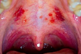 Heridas en el paladar