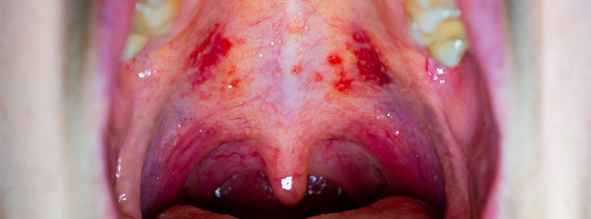 Heridas en el paladar