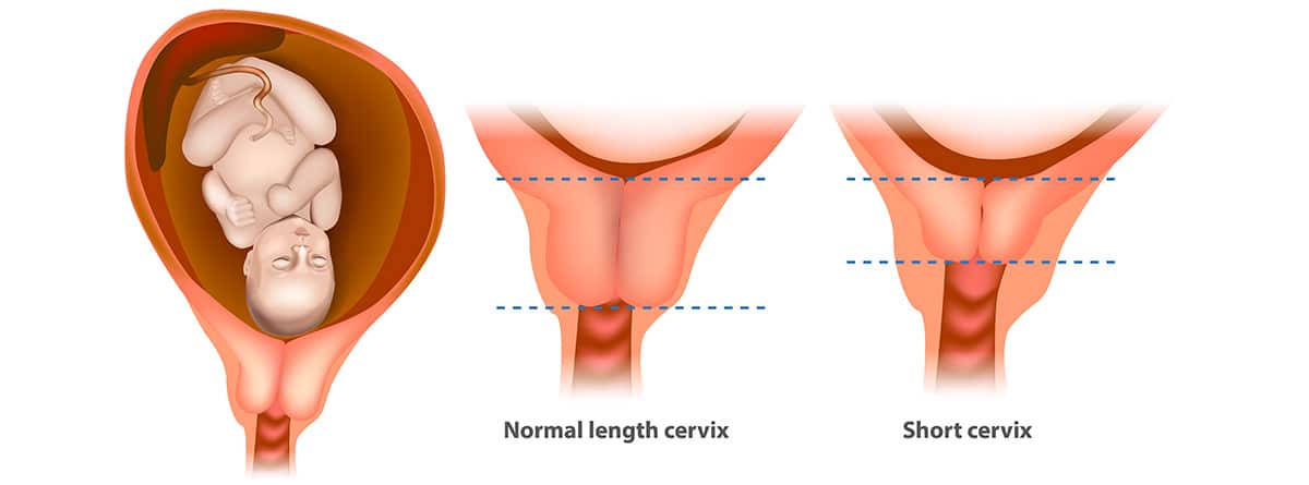 Incompetencia cervical