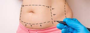 Marcas sobre un estómago antes de una operación