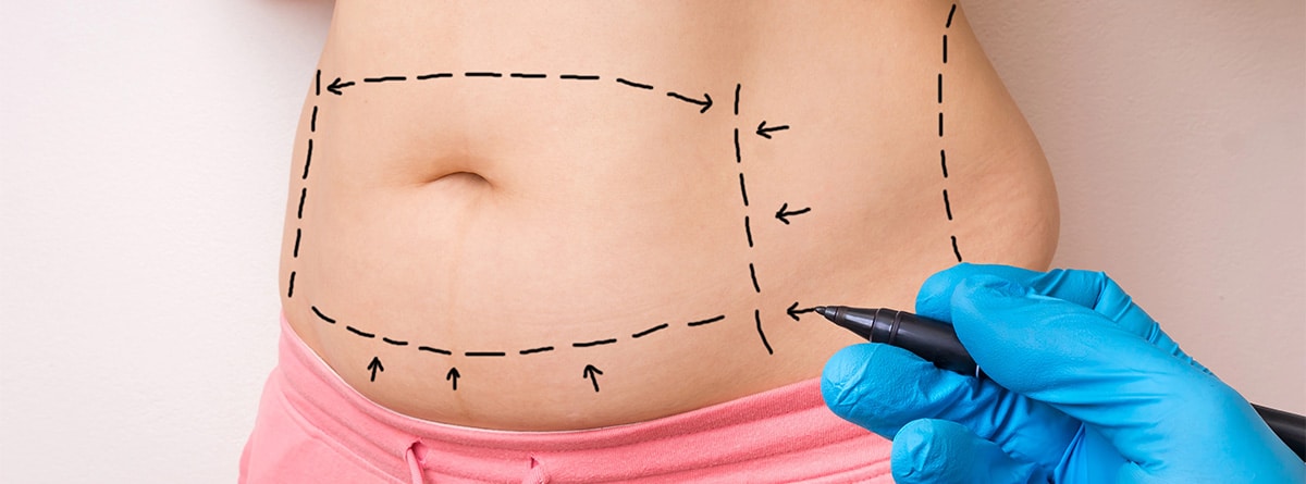 lipotransferencia Marcas sobre un estómago antes de una operación