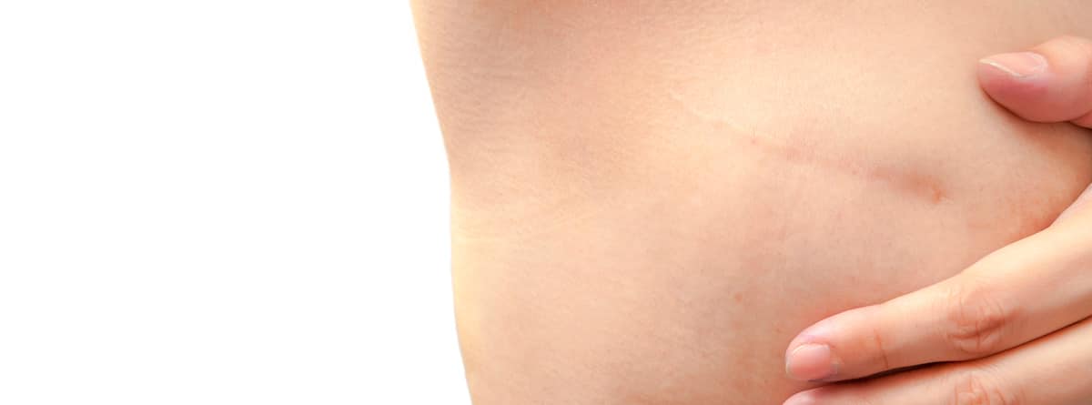 Mastectomía Mastectomía